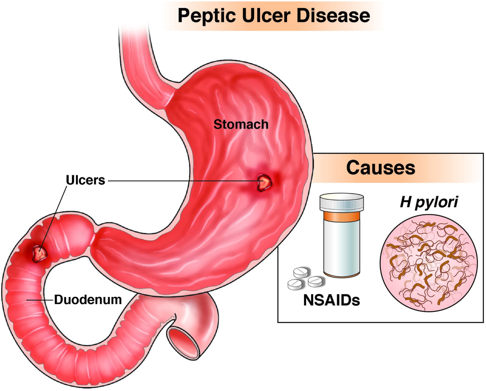 Peptic/ Stomach Ulcers & Gastritis